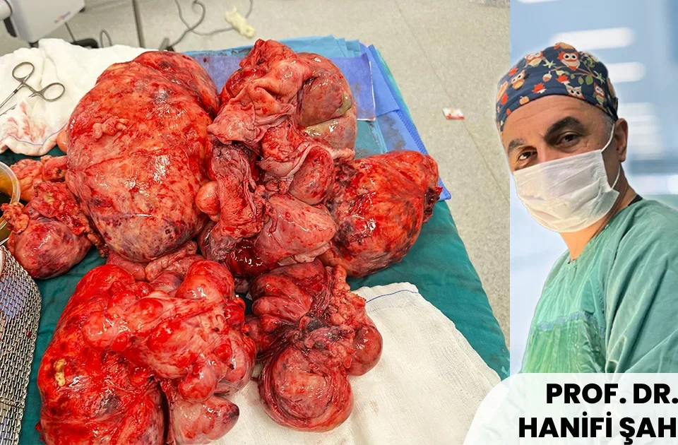 Dünyanın En Büyük Miyomu Başarıyla Çıkarıldı: 60 cm ve 17,4 kg — Rahim Korundu!