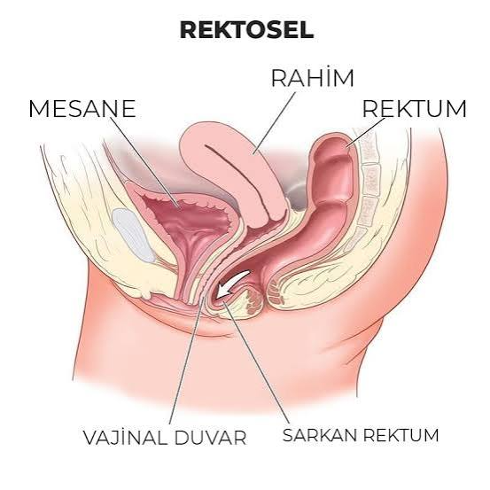 Rektosel Tedavisi Nedir?