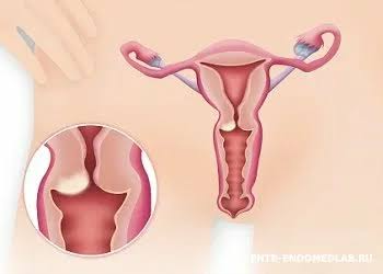 Vajina Kanseri Nedir? 