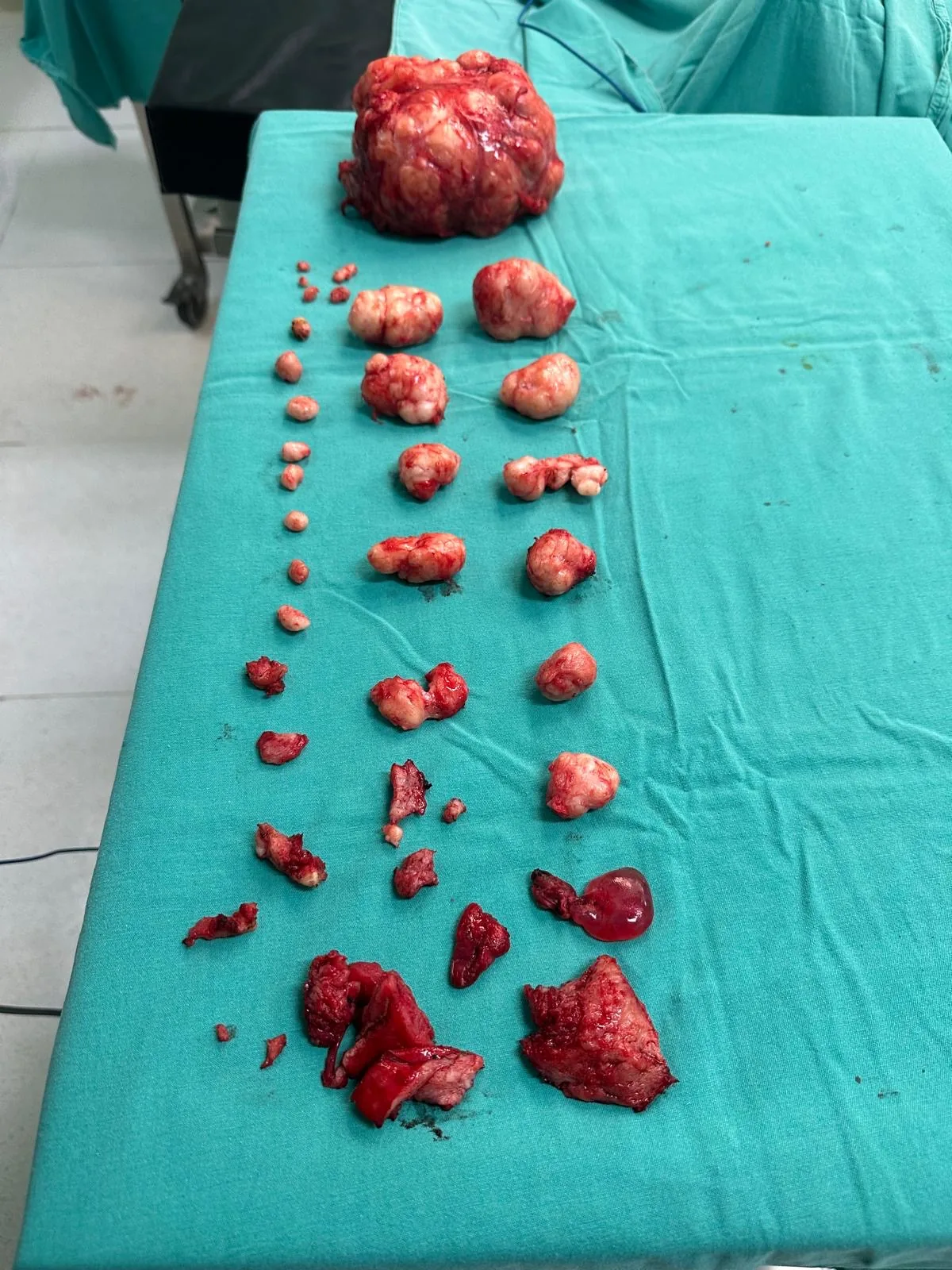 35 cm miyom kapalı ameliyatında çıkarılan dokular